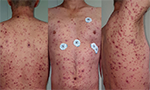 Colagem de três fotos na vertical. O corpo de um homem branco coberto por manchas vermelhas. As fotos vão do tronco até o pescoço.