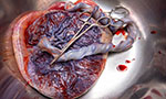 Foto de uma placenta com cordão umbilical sobre um recipiente metálico. Uma tesoura está disposta sobre a placenta cortando o cordão.
