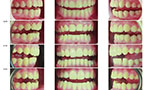 Montagem com 12 fotos de arcadas dentárias e fundo branco.